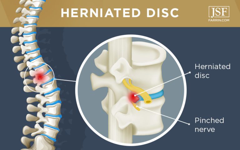 Herniated Discs & Back Injuries from Work | James Scott Farrin