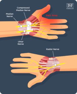 Hand Injury Compensation Amounts | James Scott Farrin